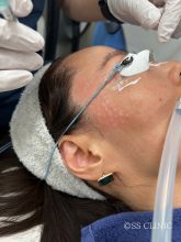 エクリン汗嚢腫 ーその6ー