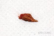 眼瞼下垂手術を応用したアクアミド除去 ーその2ー