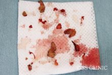 眼瞼下垂手術を応用したアクアミド除去 ーその3ー