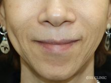 頬のシワ CGスタライラー その2