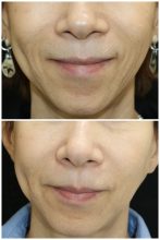 頬のシワ　CGスタイラー　その３