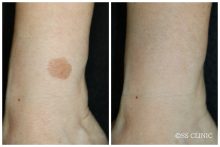 手のシミを取る！