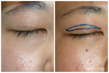 切開式重瞼術の修正