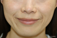 ほうれい線 ヒアルロン酸はどれくらい持つ？ 11ヵ月後の症例写真