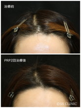 生え際の産毛が太くなる / PRP育毛2回のリアル症例